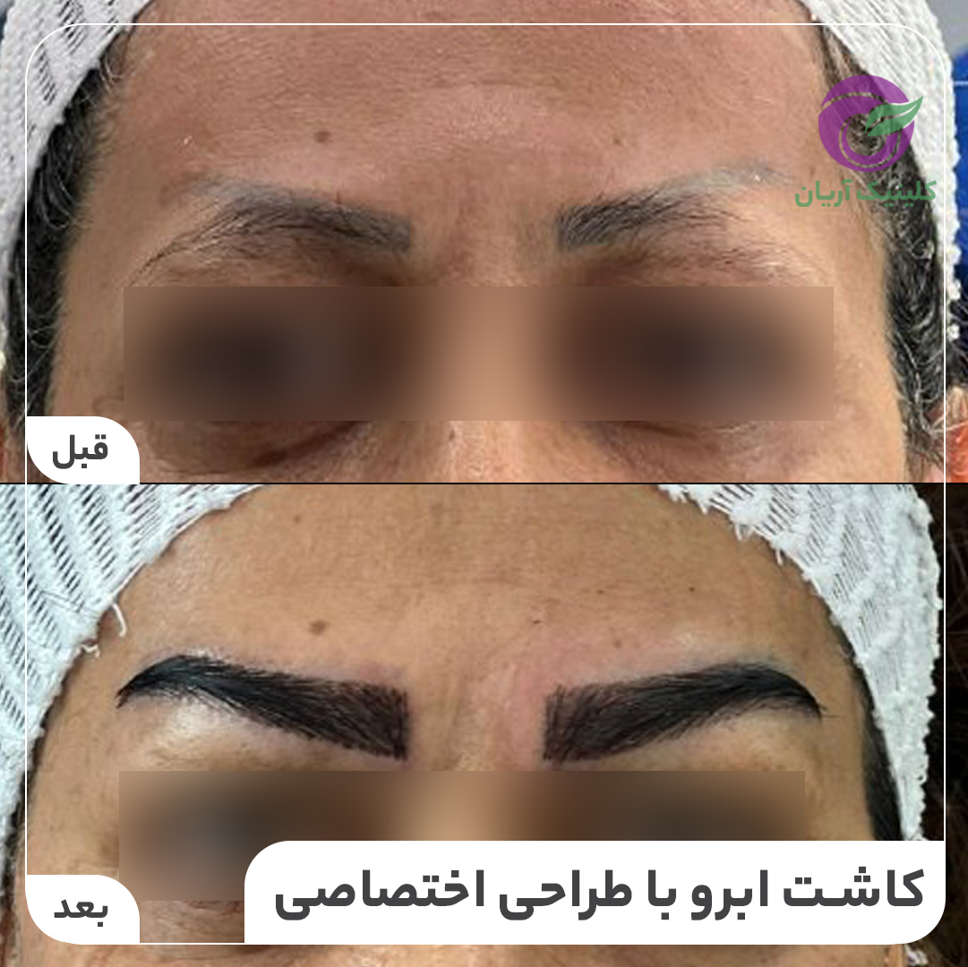 گالری فیلم کاشت ابرو